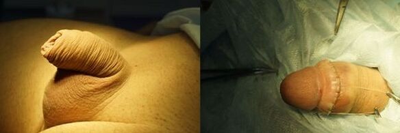 zakar sebelum dan selepas pembedahan pembesaran