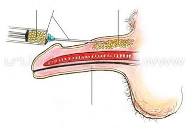 Pembesaran zakar suntikan